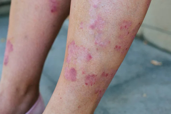 Fechar as pernas de uma mulher que sofre de psoríase crônica. Closeup de erupção cutânea e descamação na pele dos pacientes. Problemas dermatológicos. Pele seca. — Fotografia de Stock
