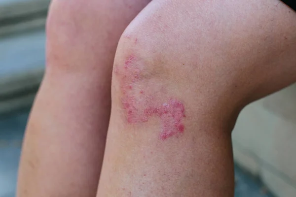 Primer plano de las piernas de una mujer que sufre de psoriasis crónica. Primer plano de erupción y descamación en la piel de los pacientes. Problemas dermatológicos. Piel seca. —  Fotos de Stock