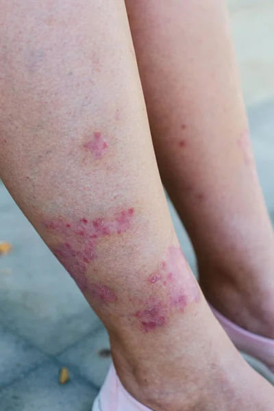 Closeup of the legs of a woman suffering from chronic psoriasis. Closeup of rash and scaling on the patients skin. Dermatological problems. Dry skin.