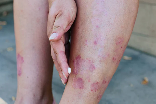 Aplicación de ungüento terapéutico para erupciones alérgicas en la pierna. Tratamiento de la psoriasis, problemas cosméticos y dermatológicos con pomada. — Foto de Stock