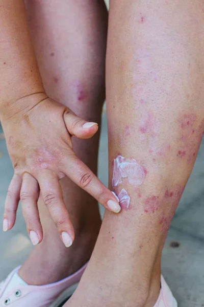 Aplicación de ungüento terapéutico para erupciones alérgicas en la pierna. Tratamiento de la psoriasis, problemas cosméticos y dermatológicos con pomada. — Foto de Stock