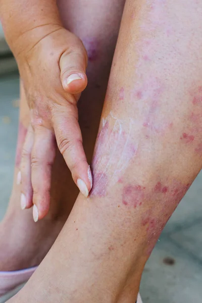 Application d'une pommade thérapeutique contre les éruptions cutanées allergiques sur la jambe. Traitement du psoriasis, problèmes cosmétiques et dermatologiques avec pommade. — Photo