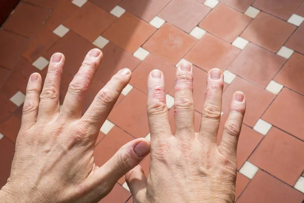 Hombre Mostrando Sus Manos Con Eczema Dedos Piel —  Fotos de Stock
