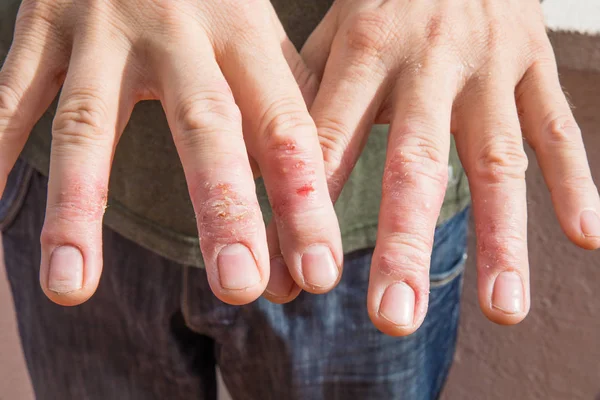 Primer Plano Del Hombre Mostrando Sus Dedos Mano Con Eczema Fotos de stock libres de derechos