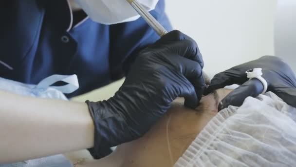 Жінка-працівник косметологічної клініки робить мікропідривну процедуру для пацієнта — стокове відео