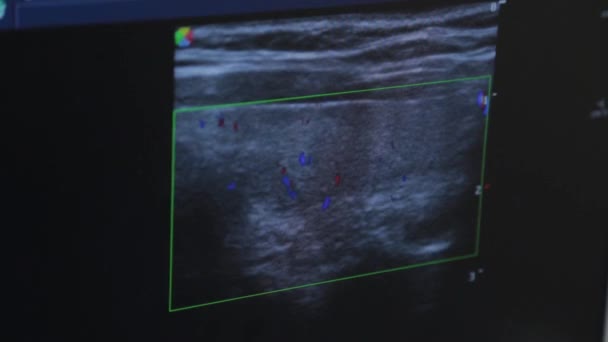 Echografie apparaat in een medisch centrum. Schermafbeelding. — Stockvideo