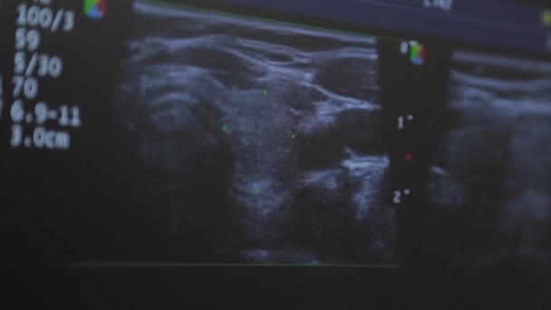 Urządzenie ultradźwiękowe w centrum medycznym. Obraz ekranu. — Wideo stockowe