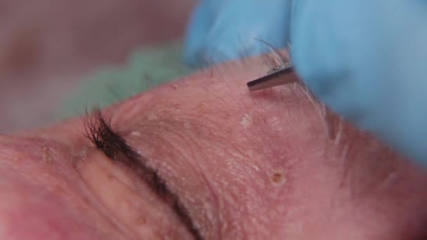Médico masculino remove papilomas de uma mulher idosa com um bisturi elétrico . — Vídeo de Stock