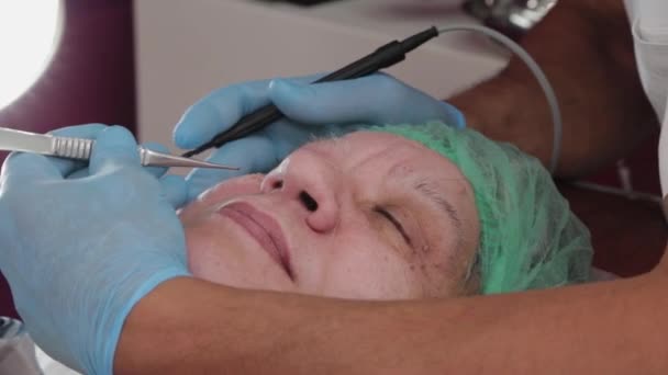Mužský lékař odstraňuje papilomy starší ženy s elektrickým skalpelem. — Stock video