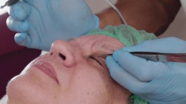 Erkek doktor, elinde neşterle yaşlı bir kadının papillomlarını alıyor..