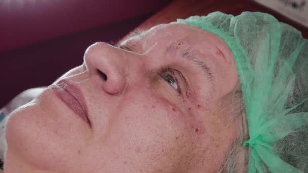 Erkek doktor, yaşlı bir kadında papilloma çıkarma bölgelerini tedavi ediyor.. — Stok video