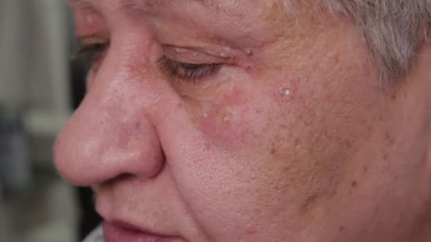 Donna anziana con papillomi sul viso al centro medico. — Video Stock