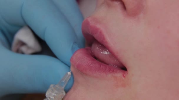Doctor cosmetólogo hace aumento de labios a la mujer. — Vídeos de Stock