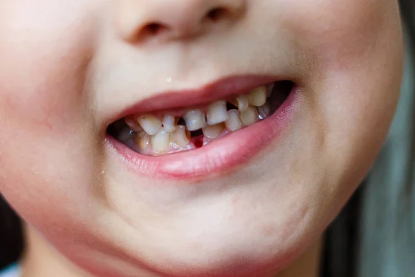 Στενή Άποψη Του Μικρού Κοριτσιού Που Δείχνει Κενά Των Δοντιών — Φωτογραφία Αρχείου