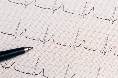 Kağıda basılmış bir elektrokardiyogramın parçası