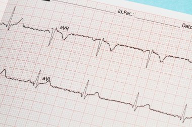 Kağıda basılmış bir elektrokardiyogramın parçası