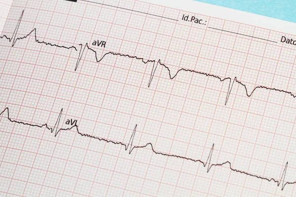 Delen Van Een Elektrocardiogram Bedrukt Papier — Stockfoto