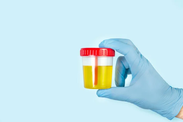 Hand Surgical Glove Holding Disposable Medical Cup Urine Analysis — Stock Photo, Image