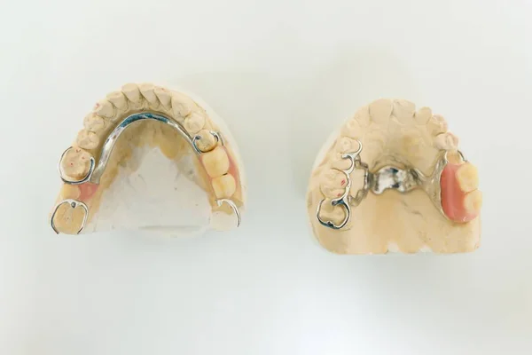 Protesi dentarie, impianti. Modello di gesso sul tavolo dal dentista — Foto Stock