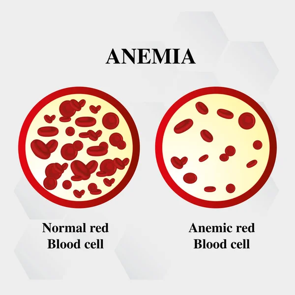 Anemia Cantidad Sangre Roja Hierro Deficiencia Anemia Diferencia Anemia Cantidad — Archivo Imágenes Vectoriales