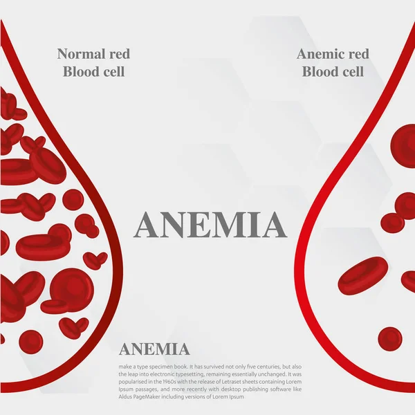 Anemia Quantità Sangue Rosso Anemia Carenza Ferro Differenza Anemia Quantità — Vettoriale Stock