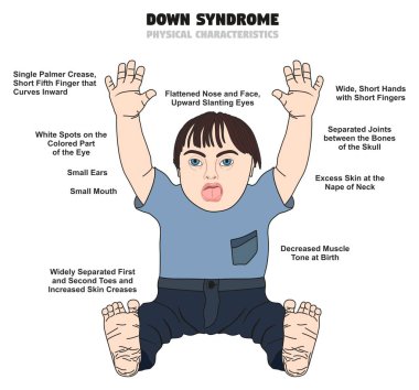 Down sendromu fiziksel özellikleri Infographic diyagramı gösteren bu sakatlık için tıbbi bilim sağlık ve insan bilinci ile doğan çocuk etkilenen