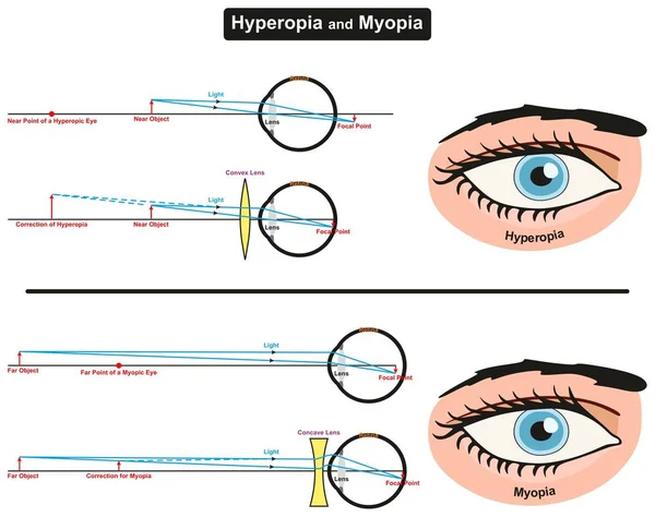 Uzak Yakın Nesne Odak Noktaları Göz Retina Düzeltme Içbükey Dışbükey — Stok Vektör