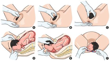 Emek ve Bebek Doğum tıbbi bilim eğitimi için tüm aşamaları dahil olmak üzere Normal teslimat adımları Infographic diyagramı 