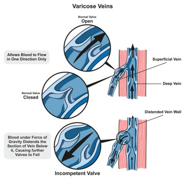 Normal vana gösteren varisli damarlar Infographic diyagramı açın ve kapalı ve tıbbi bilim eğitim ve sağlık için başarısız beceriksiz kapak karşılaştırın