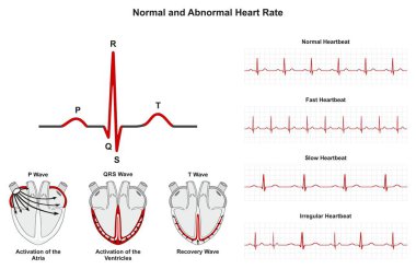 Normal ve anormal kalp hızı Infographic diyagramı etkinleştirme kulakçık ventrikül ve kurtarma dahil olmak üzere normal hızlı yavaş düzensiz sinyaller tıp bilimi eğitim ve sağlık bakım planını da dalga