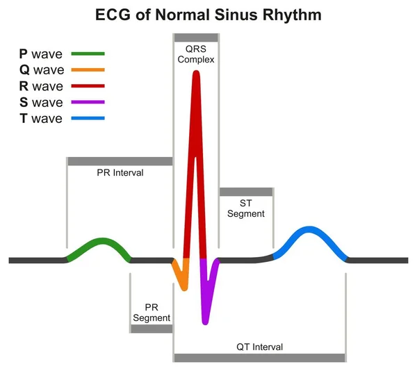 Ecg Ritmo Sinusal Normal Diagrama Infográfico Que Muestra Onda Cardiaca — Vector de stock