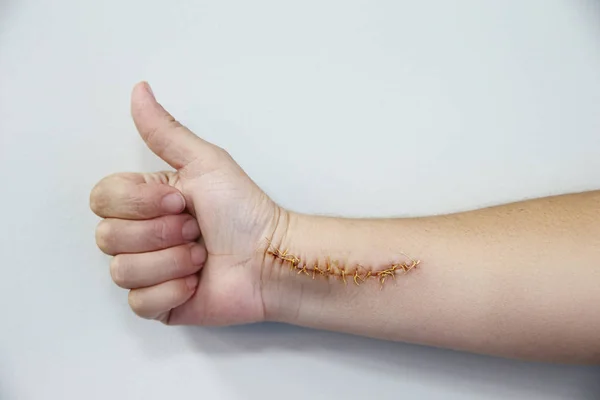 Humand Hand Hurt Big Scar Lot Stitches Horizontal Shot — Stock Photo, Image