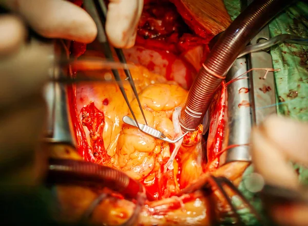 Hjärtkirurgi. Kranskärls bypass ympning. — Stockfoto