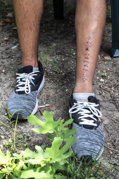 Bacak Yaralanma Dikiş Çocuk Spor Ayakkabı Ile — Stok fotoğraf