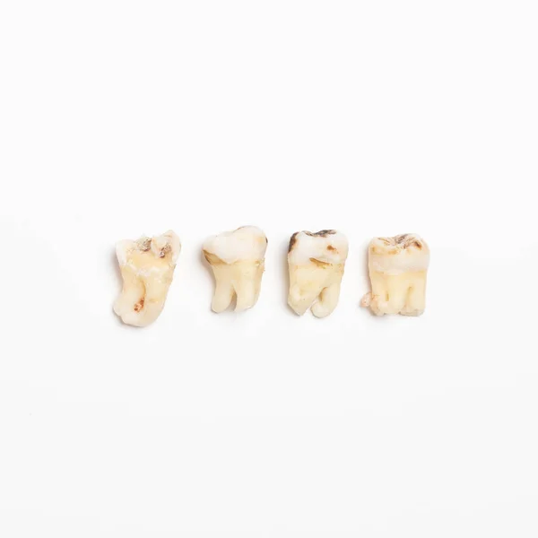 Arrancó los malos molares dientes humanos de cerca sobre fondo blanco —  Fotos de Stock