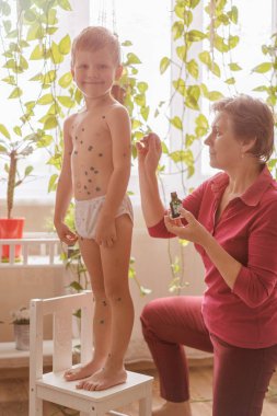 Tavuk Pox'u küçük bir erkek - bir kadın bir çocuk evde su çiçeği için davranır.