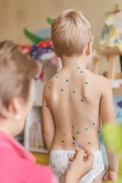 Plané neštovice v malého chlapce - žena považuje dítě doma pro plané neštovice — Stock fotografie