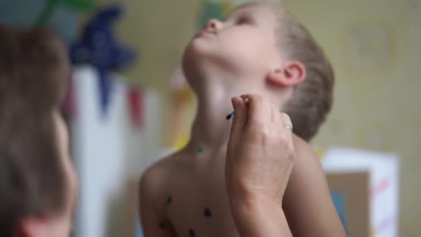 Waterpokken in een jongetje - een vrouw behandelt een kind thuis voor waterpokken - handheld schieten — Stockvideo