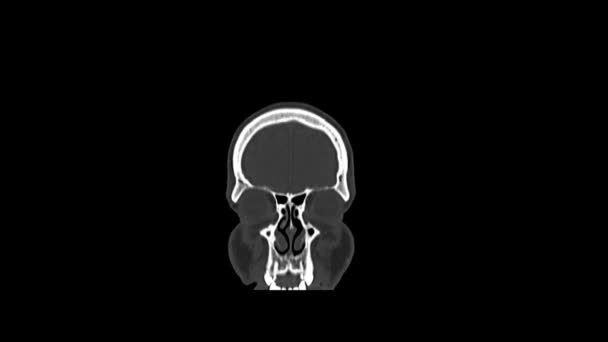 Комп'ютерна медична томографія МРТ сканування здорової чоловічого голови — стокове відео