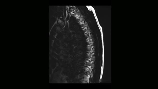 Vypočítanou lékařské tomografie magnetickou rezonancí hrudní páteře člověka s osteochondróza — Stock video