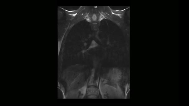 Computed medical tomography MRI scan of the thoracic spine of a man with osteochondrosis — Stock Video