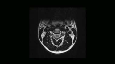 Tıbbi tomografi MRI tarama osteochondrosis bir adamla servikal omurga hesaplanan