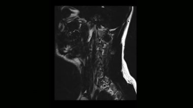 Tıbbi tomografi MRI tarama osteochondrosis bir adamla servikal omurga hesaplanan