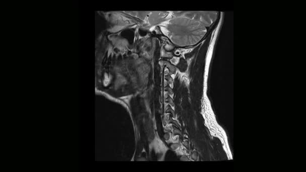 Tomografía computarizada por resonancia magnética de la columna cervical de un hombre con osteocondrosis — Vídeo de stock