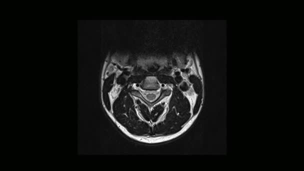 Vypočítanou lékařské tomografie magnetickou rezonancí muže s osteochondróza krční páteře — Stock video