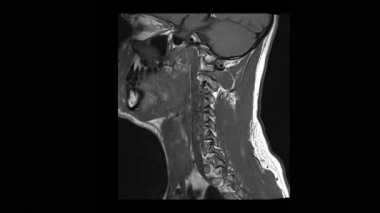 Tıbbi tomografi MRI tarama osteochondrosis bir adamla servikal omurga hesaplanan