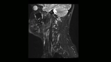 Tıbbi tomografi MRI tarama osteochondrosis bir adamla servikal omurga hesaplanan