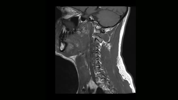 Medische tomografie Mri-scan van de cervicale wervelkolom van een man met osteochondrose berekend — Stockvideo