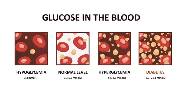Glukosespiegel im Blutbild - Hyperglykämie, Hypoglykämie, Diabetes — Stockvektor