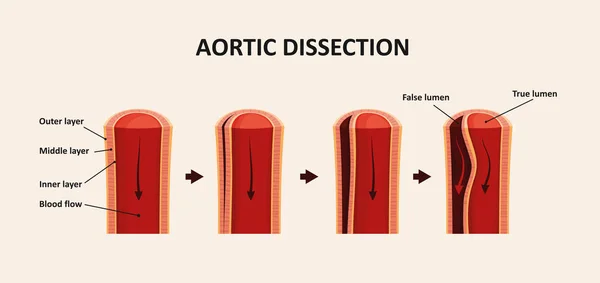 Aortadissektion Aortaaneurysm — Stock vektor